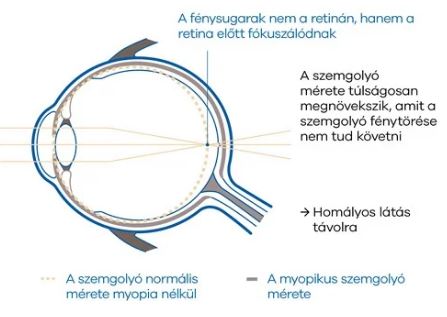 myopia